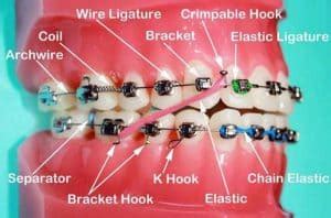 doe all metal braces brackets need wire|orthopedic wire for braces.